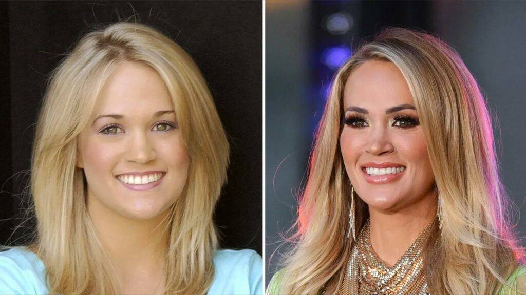 Carrie Underwood Accident Injury